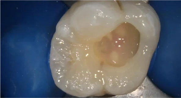 ラバーダム防湿を実施した治療の様子
