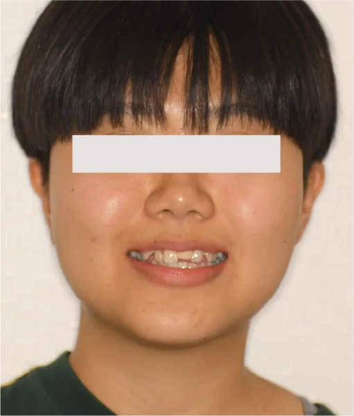 MSE（上顎拡大装置）矯正 治療前
