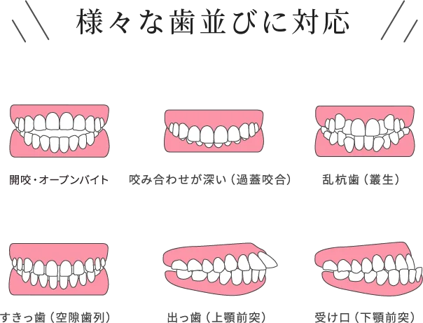 様々な歯並びに対応：開咬・オープンバイト／咬み合わせが深い（過蓋咬合）／乱杭歯（叢生）／すきっ歯（空隙歯列）／出っ歯（上顎前突）／受け口（下顎前突）