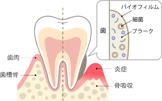 歯周病の進行イメージ図
