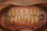 フラップ手術 治療後