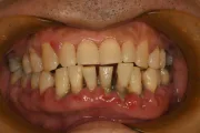 フラップ手術 治療前