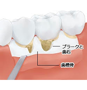 ①フラップ手術の流れ