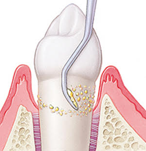 歯周病治療方法
