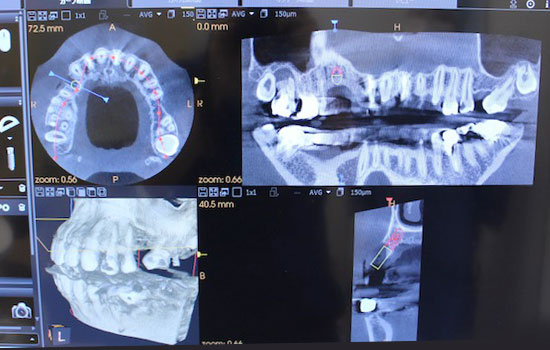 インプラント治療風景