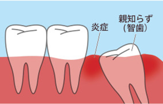 歯周病治療方法