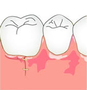③歯周組織再生療法