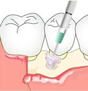 ②歯周組織再生療法