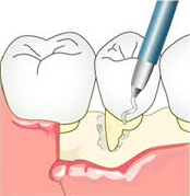 ①歯周組織再生療法